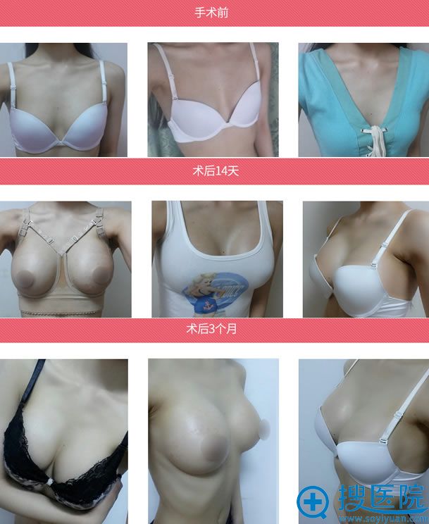 韩国麦恩整形外科李圣郁假体隆胸案例