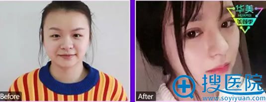 贵阳华美整形隆鼻前后对比照