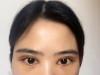 西安高一生刘军主任割双眼皮案例 3000多元收获水灵灵的大眼睛