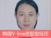 韩国妩丽林平珍院长v-line瓜子脸手术：下颌角+下巴改脸型