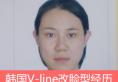 韩国妩丽林平珍院长v-line瓜子脸手术：下颌角+下巴改脸型