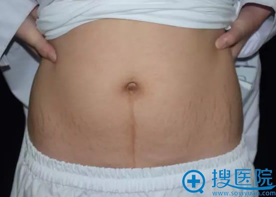 在广州华美整形医院做妊娠纹术前照