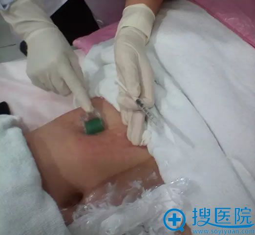 医生正在进行滚针