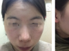 韩国欧佩拉整形外科金锡汉下颌角+颧骨+下巴轮廓三件套恢复日记