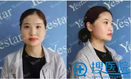 在武汉艺星整形医院隆鼻术前照