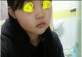 韩国妩丽整形医院林平珍面部轮廓术后日记 让我从此摆脱大圆脸