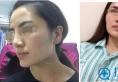 长沙哪家医院擅长磨骨?星雅李雯院长下颌角整形+颧骨缩小案例