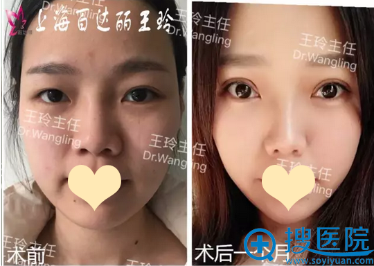 <!--<i data=20240710 data-id=14211></i>--><!--<i data=20240710 data-id=17469></i>-->双眼皮重睑修复案例