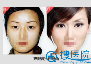 双眼皮+开眼角