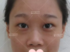 三眼皮的我找武汉美立方胡江伟医生做了双眼皮开眼角手术