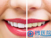 宁波美莱口腔医院牙齿美白方法：皓齿、冷光、牙齿贴面怎么选？