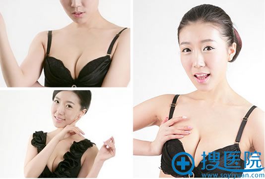 自体脂肪隆胸效果图
