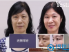去眼袋哪里做？来温州艺星看大妈外切祛眼袋后的惊人效果