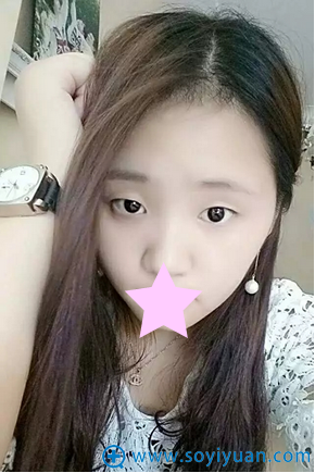 朱武根双眼皮术前照片