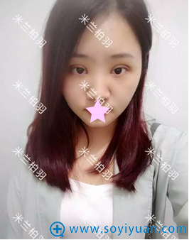 深圳米兰柏羽朱武根双眼皮5天拆线照片