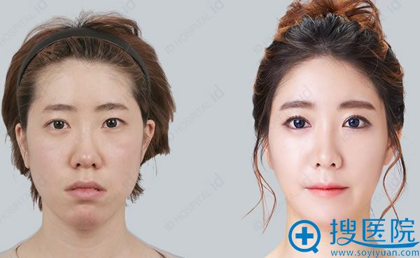 方下巴女生在韩国ID手术前后照片