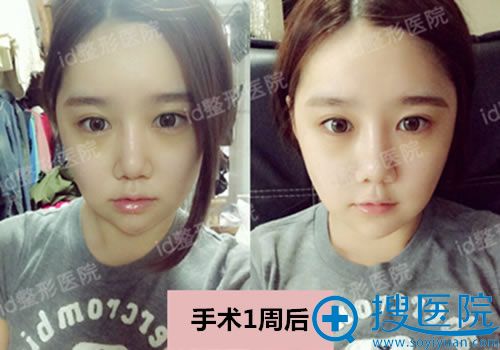 韩国ID下颌角手术1周的效果