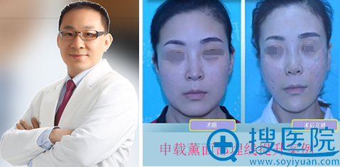 <!--<i data=20240710 data-id=11048></i>-->申载熏面部埋线提升案例
