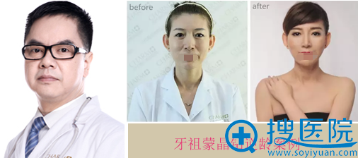 重庆当代牙祖蒙晶钻逆龄案例