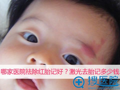 成都去除红胎记的医院及价格