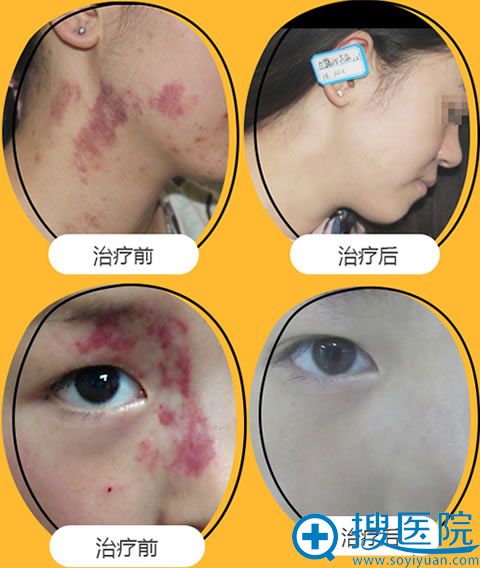 成都恒博激光去除红胎记案例