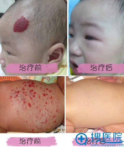 成都恒博激光去除血管瘤案例图