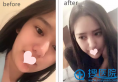 【经历】找上海薇琳孙荣做面部吸脂瘦脸1个月恢复全过程效果图