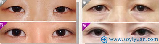 重庆华美整形双眼皮案例图