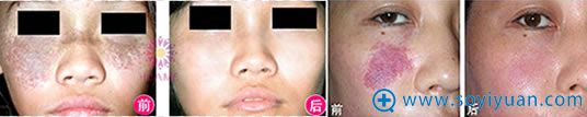重庆华美激光祛斑和祛痣案例照片