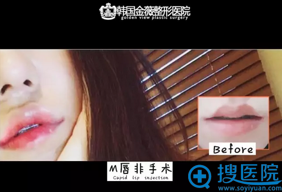 韩国金薇整形医院M唇非手术案例前后对比图