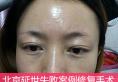 北京延世失败案例修复手术 云南爱美者跨省找金奇龙重做双眼皮