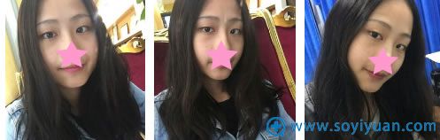 在广州星团美容医院做双眼皮术前照片
