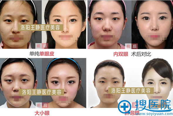<!--<i data=20240710 data-id=12334></i>-->眼部整形案例对比照片