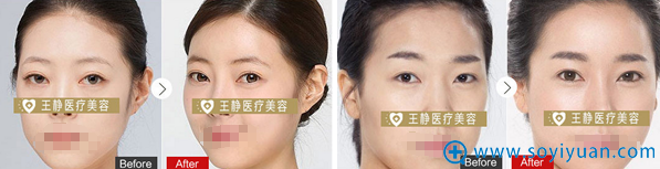 <!--<i data=20240710 data-id=12334></i>-->面部脂肪填充真人案例