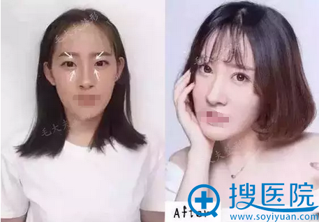 洛阳毛大夫双眼皮+开眼角术后对比照片 洛阳毛大夫双眼皮+开眼角术后对比照片