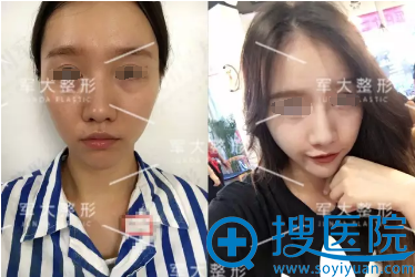 <!--<i data=20240710 data-id=15150></i>-->线雕隆鼻提拉苹果肌术后对比照