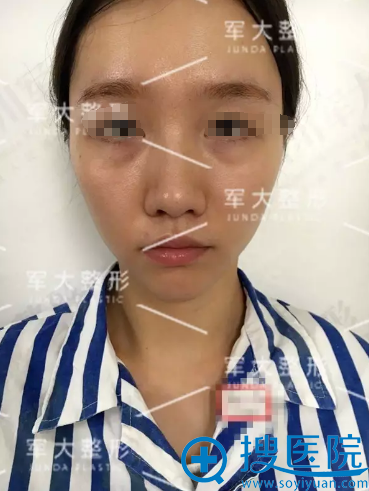 <!--<i data=20240710 data-id=15150></i>-->线雕隆鼻提拉苹果肌术前照