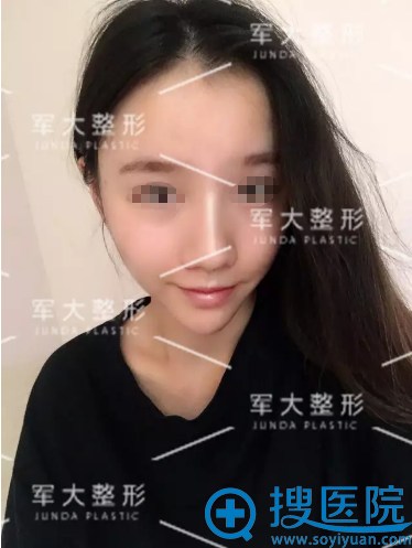 <!--<i data=20240710 data-id=15150></i>-->线雕隆鼻提拉苹果肌术后2天恢复照
