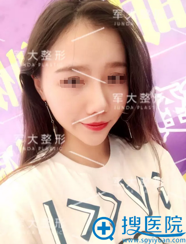 <!--<i data=20240710 data-id=15150></i>-->线雕隆鼻提拉苹果肌术后5天恢复情况