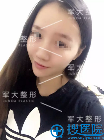 <!--<i data=20240710 data-id=15150></i>-->线雕隆鼻提拉苹果肌术后一个月恢复照
