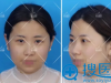 苏州美莱揭秘：鼻子基础好的人和鼻子基础不好的人的隆鼻区别