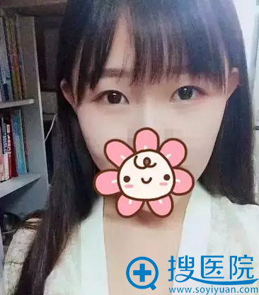 <!--<i data=20240710 data-id=12546></i>-->割双眼皮术前照