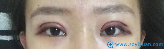 内双妹子恩喜割双眼皮天