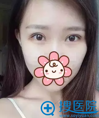 <!--<i data=20240710 data-id=12546></i>-->割双眼皮拆线后效果