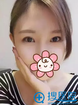 双眼皮术后5个月恢复照片