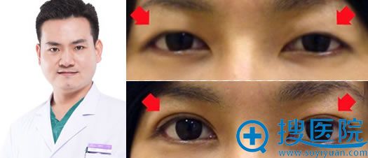 合肥韩美医生推荐及闫品行双眼皮案例