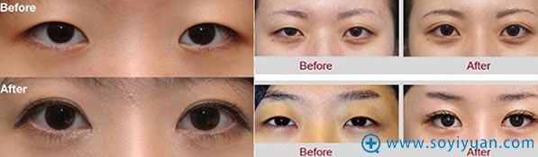 <!--<i data=20240710 data-id=16809></i>-->院长双眼皮案例图 <!--<i data=20240710 data-id=16809></i>-->院长双眼皮案例图