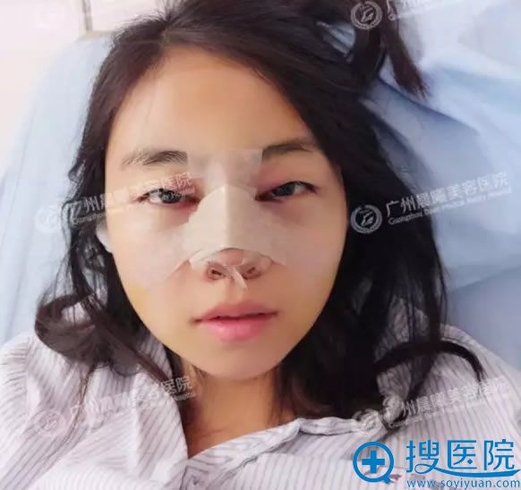 鼻综合术后第2天照片