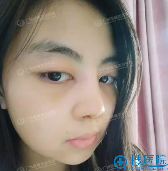 膨体隆鼻和鼻翼缩小术后13天已经拆线