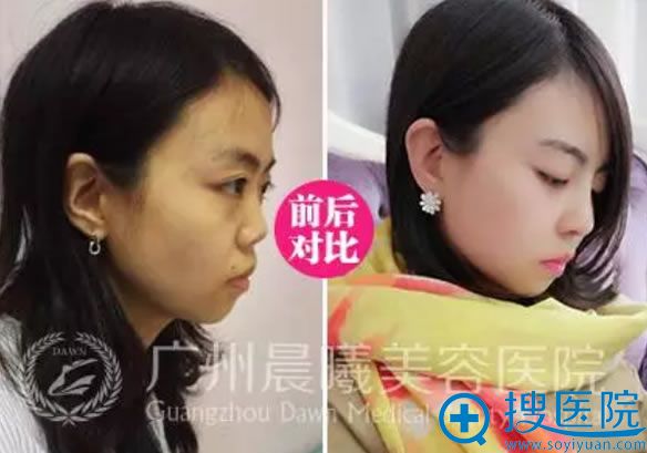 陈柯鼻综合整形前后对比案例